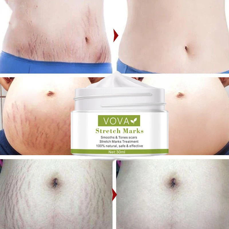 Anti-Stretch Marks Scar Removal Cream - Image 3