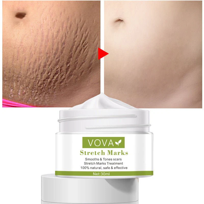 Anti-Stretch Marks Scar Removal Cream - Image 4