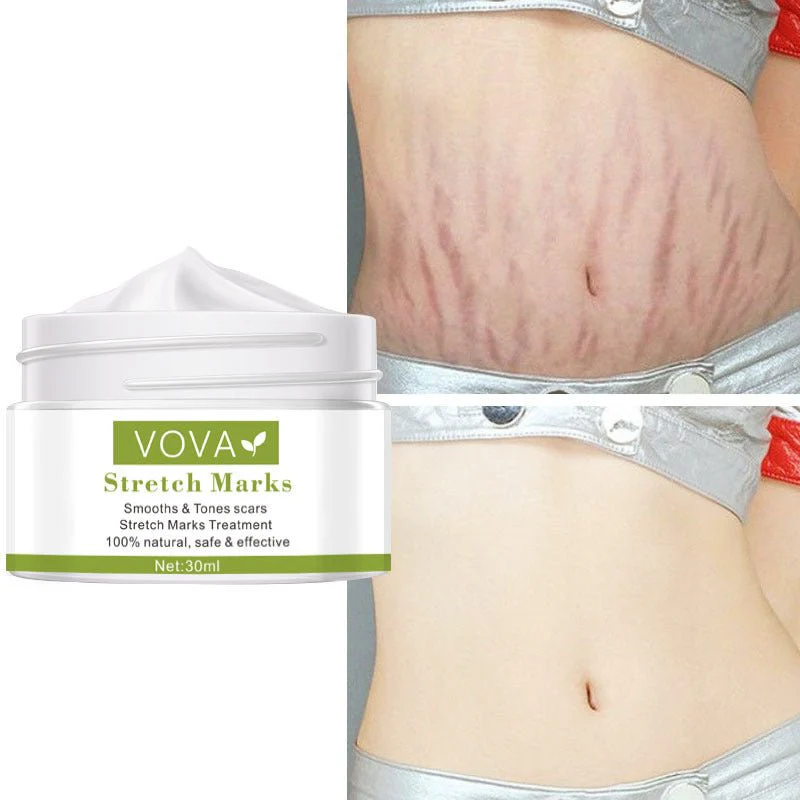 Anti-Stretch Marks Scar Removal Cream - Image 5